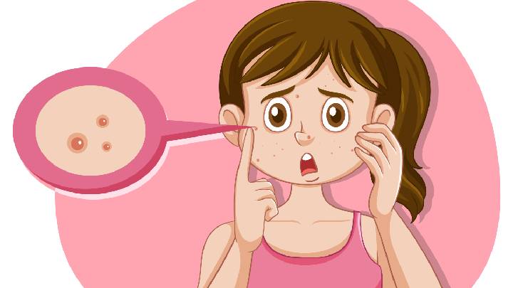 Pimple Pus: What It Is, How to Treat and Prevent?
