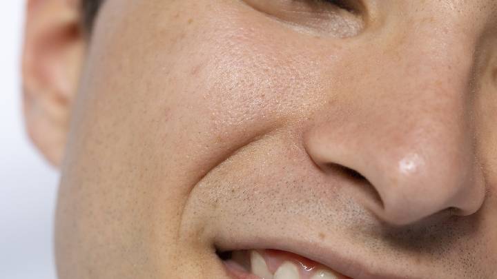 How to Treat Large Facial Open Pores?