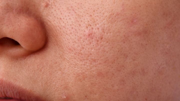 What Causes Large Pores and How Do I Treat Them?