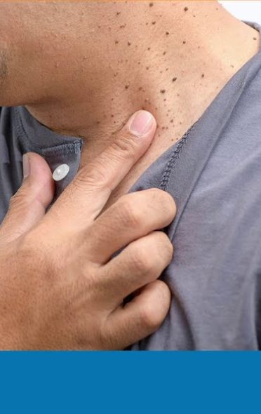 WARNING Signs of DIABETES on SKIN & Treatment