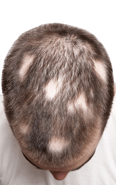 Hair Loss