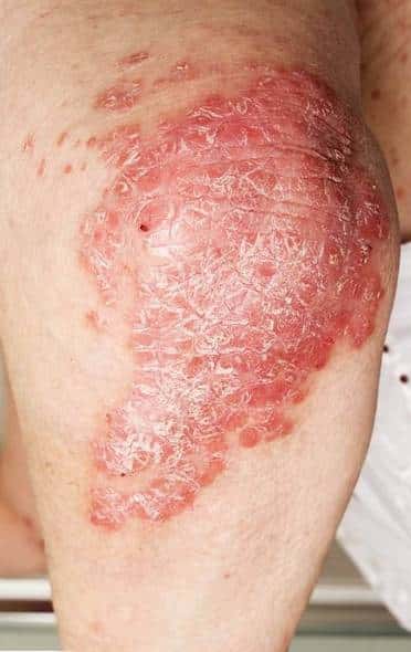 Eczema