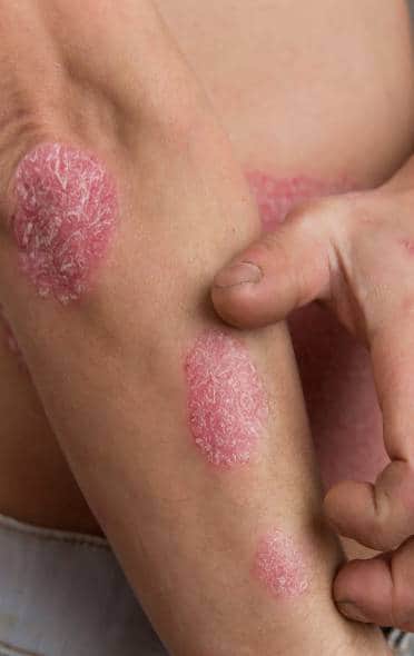 Psoriasis