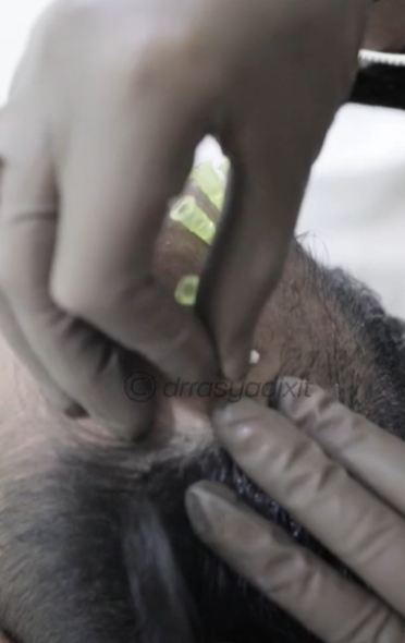 PDO Threads For Hair Growth | Best Dermatologist In Bangalore | Dr. Rasya Dixit