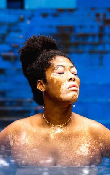 Vitiligo Treatment